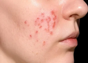 Ilustrasi wajah menunjukkan kondisi jerawat hormonal—menyoroti bagaimana jerawat jenis ini bisa bertahan di area rahang dan dagu. (Sumber: plasthetic.com)