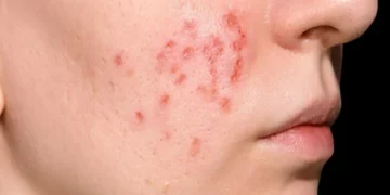 Ilustrasi wajah menunjukkan kondisi jerawat hormonal—menyoroti bagaimana jerawat jenis ini bisa bertahan di area rahang dan dagu. (Sumber: plasthetic.com)