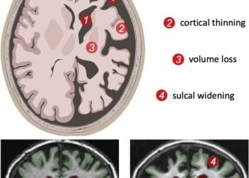 Ilustrasi pemindaian otak yang menunjukkan perbedaan jaringan otak sehat dan yang mengalami penuaan—visual ini mendukung konteks penelitian tentang penuaan kognitif.