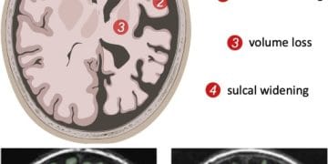 Ilustrasi pemindaian otak yang menunjukkan perbedaan jaringan otak sehat dan yang mengalami penuaan—visual ini mendukung konteks penelitian tentang penuaan kognitif.