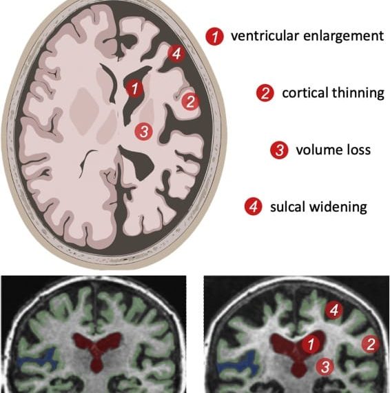 Ilustrasi pemindaian otak yang menunjukkan perbedaan jaringan otak sehat dan yang mengalami penuaan—visual ini mendukung konteks penelitian tentang penuaan kognitif.