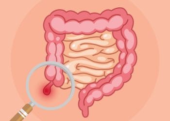 Operasi usus buntu bisa gratis pakai BPJS Kesehatan, asalkan peserta aktif dan jalur rujukan dipenuhi. Simak syarat, alur, dan hal-hal penting yang perlu kamu tahu. (Sumber: Halodoc)