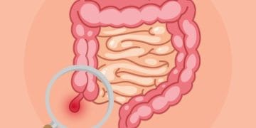 Operasi usus buntu bisa gratis pakai BPJS Kesehatan, asalkan peserta aktif dan jalur rujukan dipenuhi. Simak syarat, alur, dan hal-hal penting yang perlu kamu tahu. (Sumber: Halodoc)