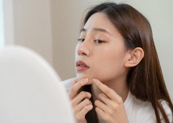 Jerawat di dagu sering muncul dan sulit hilang? Kenali penyebabnya mulai dari hormon, pola makan, hingga gaya hidup, serta temukan solusi efektif untuk mengatasinya. Foto: Freepik