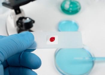 Alpha thalassemia adalah kelainan darah genetik yang sering tak disadari. Kenali gejala dan pentingnya deteksi dini untuk menjaga kesehatan tubuh. Foto: Freepik