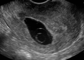 Blighted ovum adalah kondisi kehamilan tanpa embrio. Kenali gejala, penyebab, dan pilihan pengobatannya secara medis. (Foto: hellosehat.com)