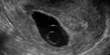 Blighted ovum adalah kondisi kehamilan tanpa embrio. Kenali gejala, penyebab, dan pilihan pengobatannya secara medis. (Foto: hellosehat.com)