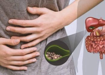 Cegah batu empedu sejak dini dengan menghindari makanan tinggi lemak, kolesterol, dan karbohidrat olahan yang kerap dikonsumsi sehari-hari. (Foto: rs-jih.co.id).