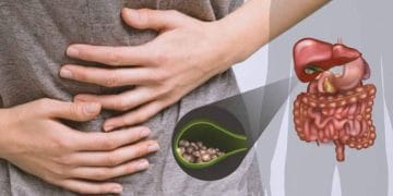 Cegah batu empedu sejak dini dengan menghindari makanan tinggi lemak, kolesterol, dan karbohidrat olahan yang kerap dikonsumsi sehari-hari. (Foto: rs-jih.co.id).