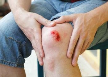 Cara alami menyembuhkan luka tanpa obat kimia. Bahan seperti lidah buaya dan marigold bisa bantu kulit pulih lebih cepat. (Foto: Alodokter)