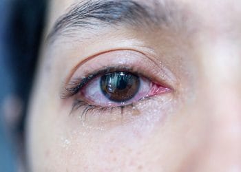 Penyakit ginjal bisa menimbulkan gejala pada mata. Kenali tanda-tanda seperti mata bengkak, kering, dan penglihatan kabur agar bisa ditangani lebih awal. (Foto: Shutterstock)