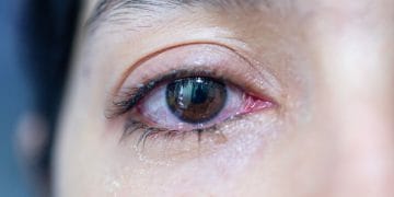 Penyakit ginjal bisa menimbulkan gejala pada mata. Kenali tanda-tanda seperti mata bengkak, kering, dan penglihatan kabur agar bisa ditangani lebih awal. (Foto: Shutterstock)