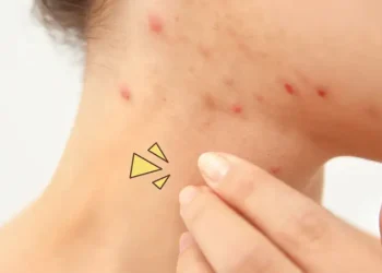 Ketahui penyebab jerawat di leher dan cara efektif mengatasinya dengan perawatan yang tepat agar kulit tetap bersih, sehat, dan bebas iritasi. (Foto: Tiege.com)