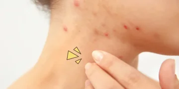 Ketahui penyebab jerawat di leher dan cara efektif mengatasinya dengan perawatan yang tepat agar kulit tetap bersih, sehat, dan bebas iritasi. (Foto: Tiege.com)