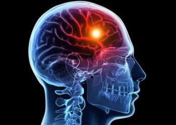 Stroke tak hanya menyerang lansia, tapi juga usia muda. Kenali gejala tersembunyinya agar bisa mencegah risiko kematian dan disabilitas permanen. (Foto: labcito.co.id)