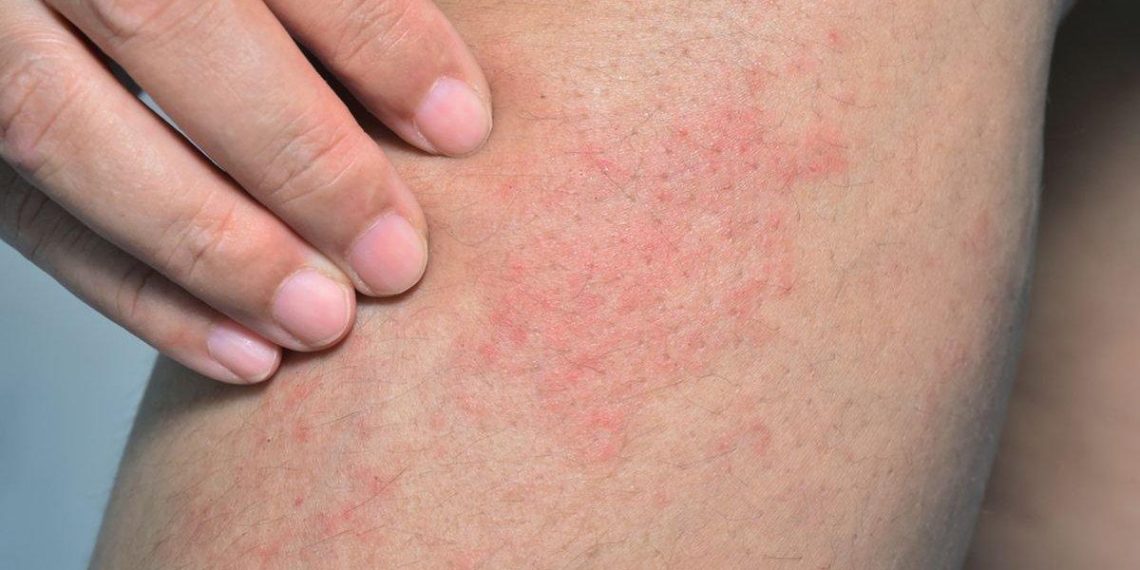 Kulit kering dan gatal bisa menjadi tanda masalah kesehatan serius. Simak penyebab medis yang dijelaskan pakar untuk memahami gejala ini. (Foto: Kompas.com)