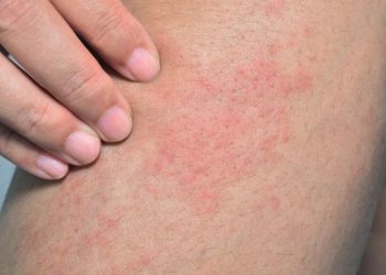 Kulit kering dan gatal bisa menjadi tanda masalah kesehatan serius. Simak penyebab medis yang dijelaskan pakar untuk memahami gejala ini. (Foto: Kompas.com)