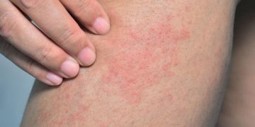 Kulit kering dan gatal bisa menjadi tanda masalah kesehatan serius. Simak penyebab medis yang dijelaskan pakar untuk memahami gejala ini. (Foto: Kompas.com)