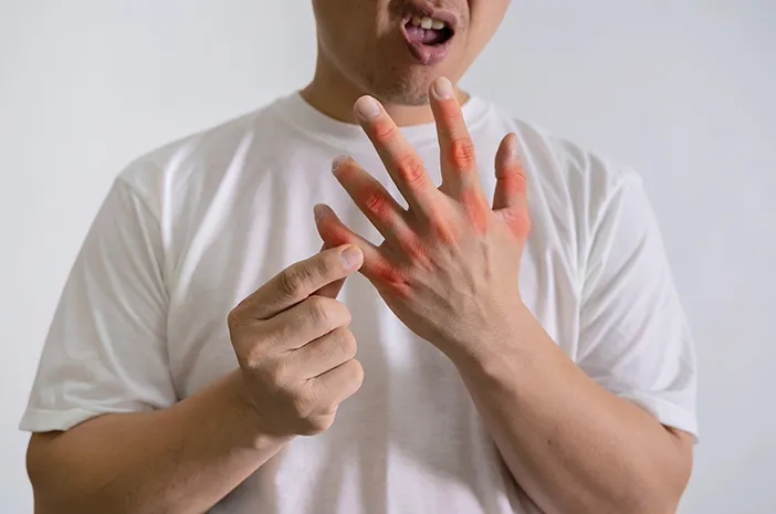 Tanpa Disadari, Makanan Ini Bisa Memperparah Asam Urat Beberapa makanan favorit ternyata bisa memicu kambuhnya asam urat. Simak daftar dan penjelasan lengkapnya di sini. (Foto: Halodoc)