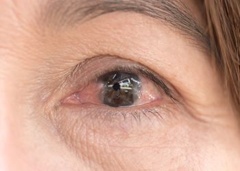 Lemak mata bisa dipicu pterygium, pinguecula, hingga xanthelasma. Kenali penyebab dan faktor risikonya agar bisa dicegah sejak dini. (Foto: Halodoc)