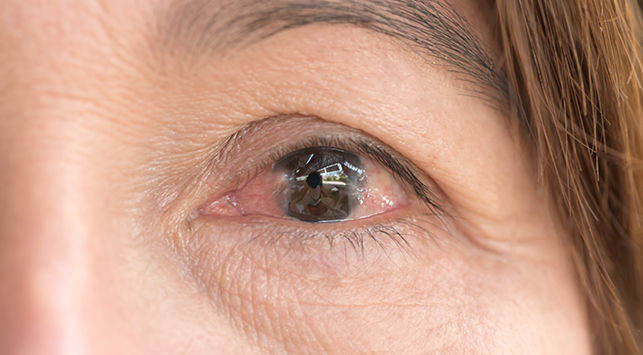 Waspada Lemak Mata, Kenali Beragam Penyebab dan Faktor Risikonya