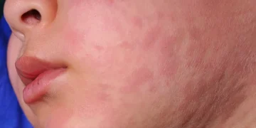 Kemenkes mengingatkan masyarakat mewaspadai penularan campak saat libur Lebaran karena mobilitas tinggi dan potensi kerumunan.