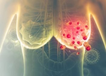 Benjolan di payudara tidak selalu kanker, tetapi bisa menjadi tanda tumor. Kenali gejala awal dan pentingnya deteksi dini untuk mencegah risiko serius. (Foto: Pixabay.com)