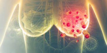 Benjolan di payudara tidak selalu kanker, tetapi bisa menjadi tanda tumor. Kenali gejala awal dan pentingnya deteksi dini untuk mencegah risiko serius. (Foto: Pixabay.com)