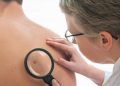Kenali gejala awal kanker kulit melanoma melalui metode ABCDE agar perubahan pada tahi lalat dapat dideteksi lebih dini sebelum penyakit berkembang.