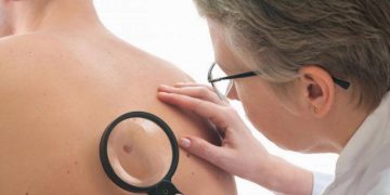 Kenali gejala awal kanker kulit melanoma melalui metode ABCDE agar perubahan pada tahi lalat dapat dideteksi lebih dini sebelum penyakit berkembang.