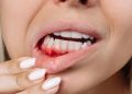 Gusi berdarah akibat periodontitis ternyata dapat berkaitan dengan penurunan fungsi ginjal. Simak hasil penelitian terbaru dan penjelasan para ahli.