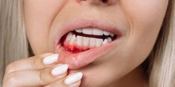 Gusi berdarah akibat periodontitis ternyata dapat berkaitan dengan penurunan fungsi ginjal. Simak hasil penelitian terbaru dan penjelasan para ahli.