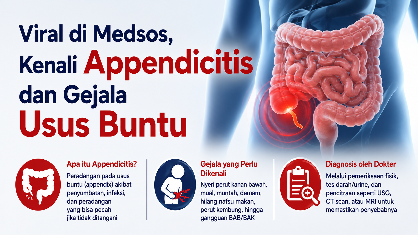 Viral di Medsos, Kenali Appendicitis dan Gejala Usus Buntu